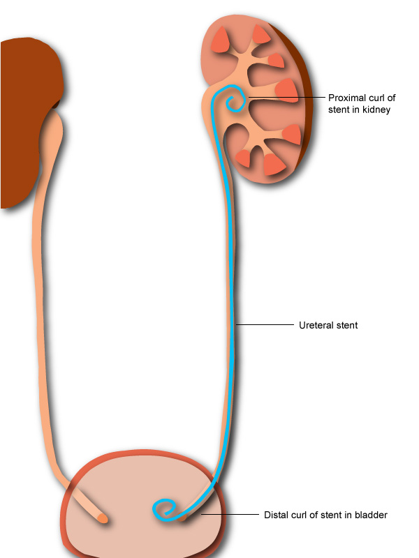 Ureteral stent